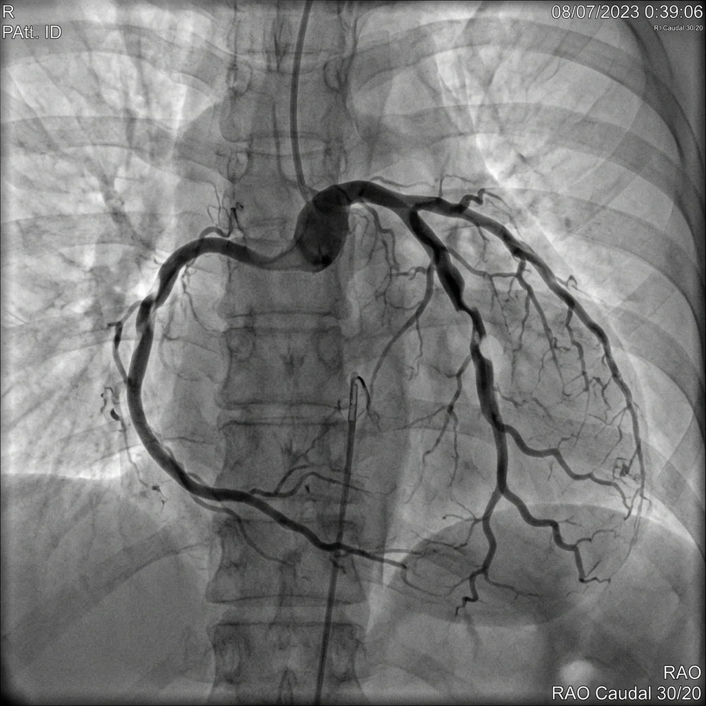 Coronary Angiography